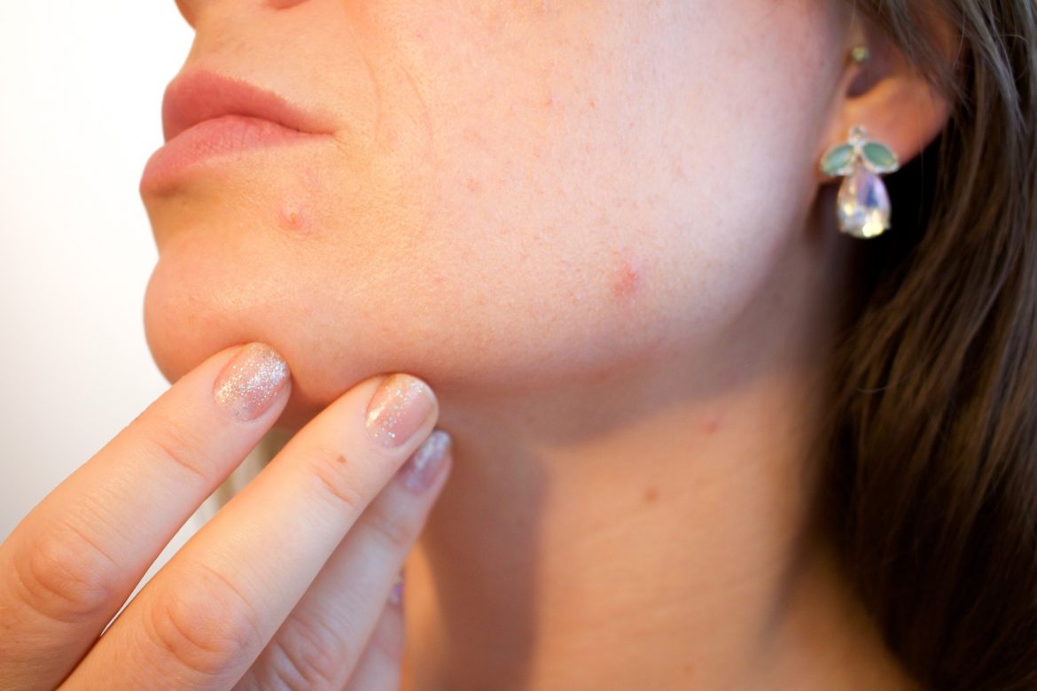 Comment réduire l’apparition de l’acné ?